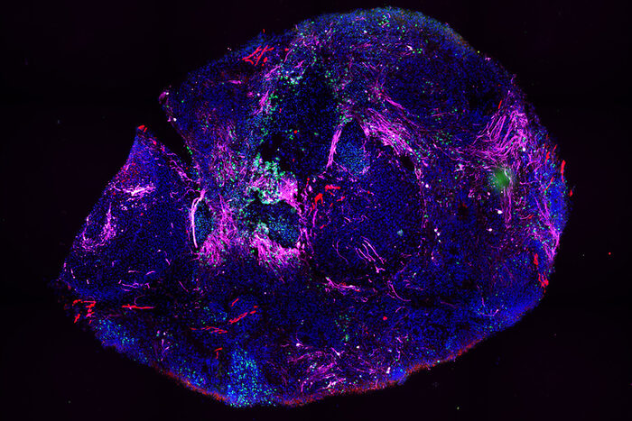 Hope for new therapeutic approaches: In Dresden, research is being conducted into the rare nerve disease SMA - also using cultured tissue samples from the laboratory.